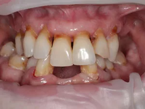 all on four dental implants before