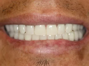 dental implants after
