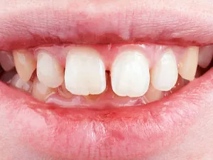 invisalign before
