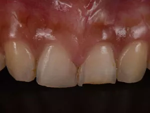 porcelain veneers before